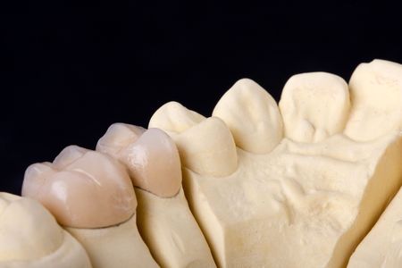 detail dental wax model over black background の写真素材