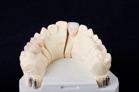 detail dental wax model ower black backgroundの写真素材