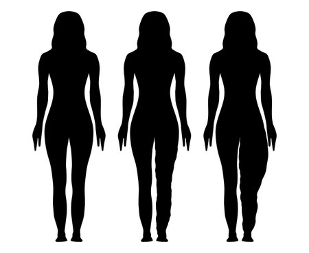 Lymphedema Silhouette Illustration with Woman with Normal and Lipedema Stagesのイラスト素材