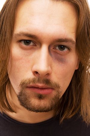 Young man with black eye on white backgroundの写真素材