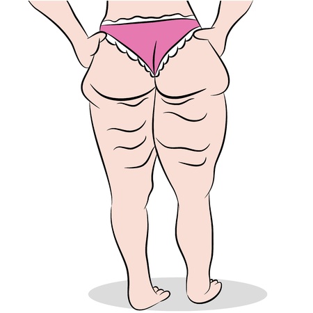 An image of a woman with cellulite on her thighs.のイラスト素材