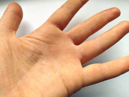 Female hand with dry atopic skin. White background. Close-up of the skin on the palm and fingers. Derma in need of care and hydration. Wrinkles, dryness and irritation on the palm lines.の写真素材