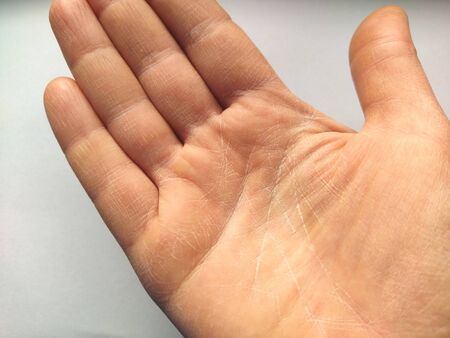 Female hand with dry atopic skin. White background. Close-up of the skin on the palm and fingers. Derma in need of care and hydration. Wrinkles, dryness and irritation on the palm lines.の写真素材
