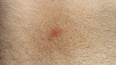 Acne. A single boil in the thickness of the skin. Light skin with a red pimple