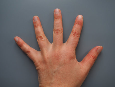 Spread 5 fingers. Female hand with dry atopic skin. White background. Close-up of the skin on the...