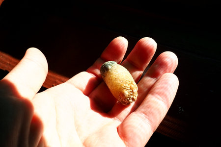 Gallstone disease, cholelithiasis - the formation of stones, stones in the gallbladder, bile ducts....