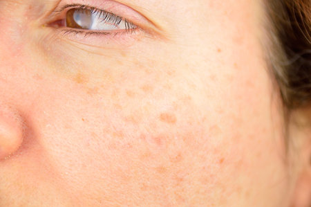 closeup of a woman cheek with liver spot causes by the large exposition sun 