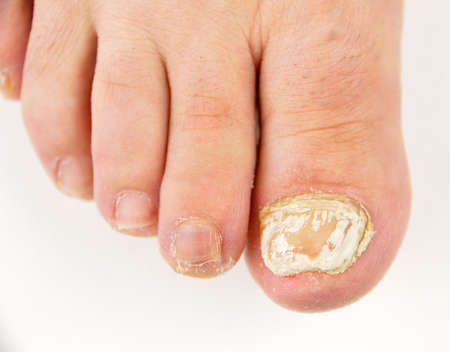 Close up image of left foot toe nail suffering from fungus infection. White background horizontal studio pictureの写真素材