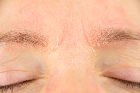 woman with symptom of atopic dermatitis on brow and browsの写真素材
