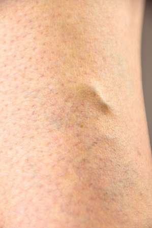 Varicose vein women Isolated on white background