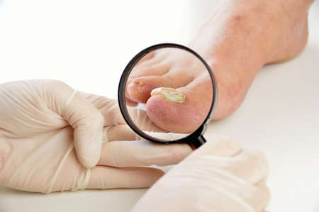 Closeup image of podologist checking with magnifying glasses the left foot toe nail suffering from fungus infection. horizontal studio picture on white background.の写真素材