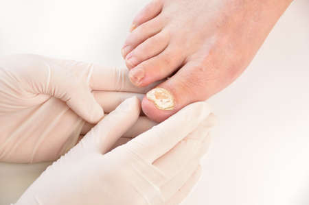 Closeup image of podologist checking the left foot toe nail suffering from fungus infection. horizontal studio picture on white background.