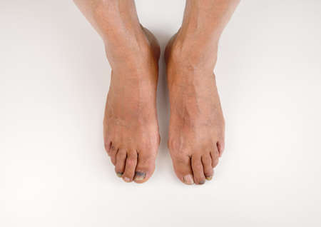 High angle shot of a two feet with subungual hematoma blue and black toe nailの写真素材