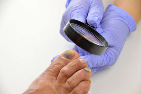 Closeup image of podologist checking the left foot toe nail suffering from subungual hematoma blue and black toe nail with a magnifying glassの写真素材