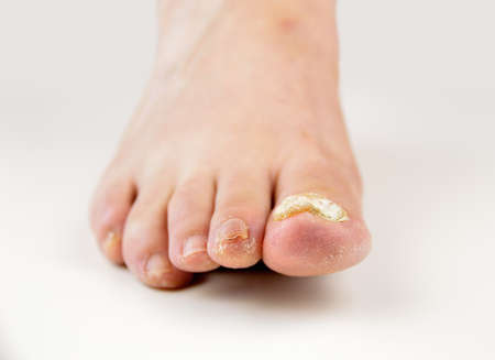 Close up image of left foot toe nail suffering from fungus infection. White background horizontal studio pictureの写真素材