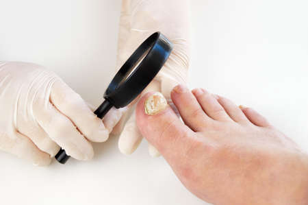 podiatrist checking a sick nailの写真素材