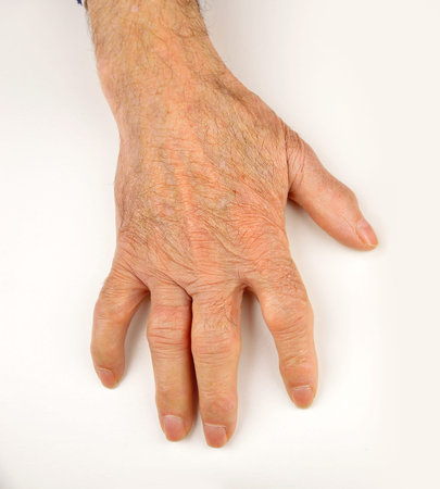 close-up of elderly hand with rheumatoid arthritis and white background