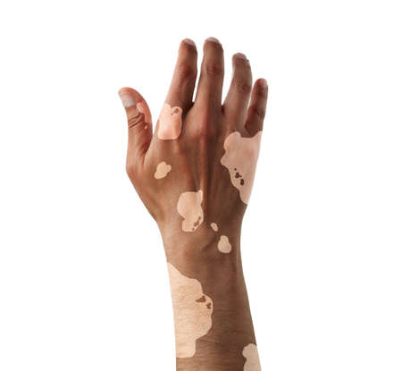Vitiligo on the hand with white backgroundの写真素材