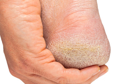 Cropped shot of a female heel with hardened skinの写真素材