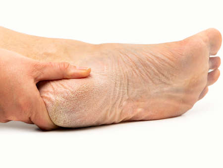 Cropped shot of a woman has dry skin and calluses on the feetの写真素材