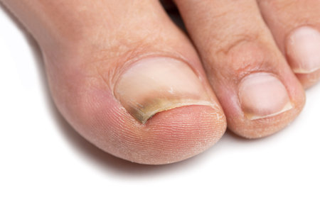 Close up image of a finger with nail fungus infection