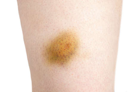 Close-up of bruise of hitting in the leg of woman on white backgroundの写真素材