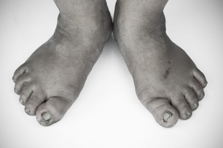 monochrome or back and white of dirty foot or cracked heels isolate on white background, medical or...