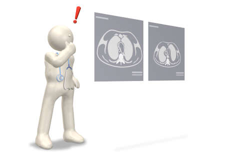 Discovery of disease  This is a computer generated image,with white background  の写真素材