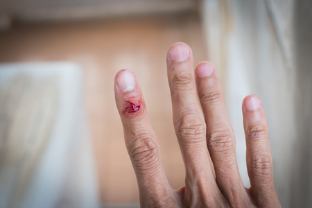 Close up finger injury from accident,selective focus.の写真素材