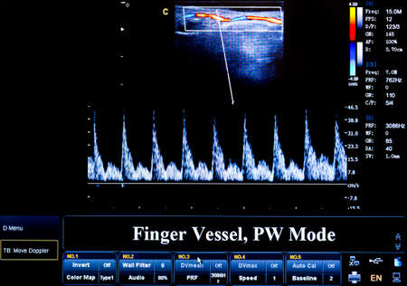 Modern echocardiography (ultrasound) machine monitor. Colour image. New hospitl equipment. image. Finger Vessel.の写真素材