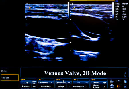 Modern echocardiography (ultrasound) machine monitor. Colour image. New hospitl equipment. Venous Valve.の写真素材