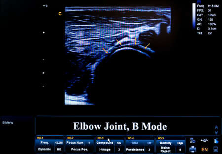 Modern echocardiography (ultrasound) machine monitor. Colour image. New hospitl equipment. Elbow Joint, B Mode.の写真素材