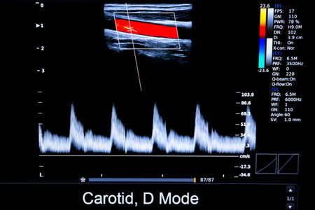 Colourful image of modern ultrasound monitor. Ultrasonography machine. High technology medical and healthcare equipment. Ultrasound imaging or sonography used in medicine. Human heart. Carodit.の写真素材