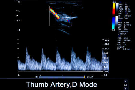 Colourful image of modern ultrasound monitor. Ultrasonography machine. High technology medical and healthcare equipment. Ultrasound imaging or sonography used in medicine. Thumb artery.の写真素材