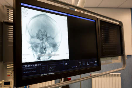 Human head X-ray image on a computer monitor in a new neurosurgery room in a modern hospital specialized in treatment of cerebrovascular diseases. Human skull.の写真素材