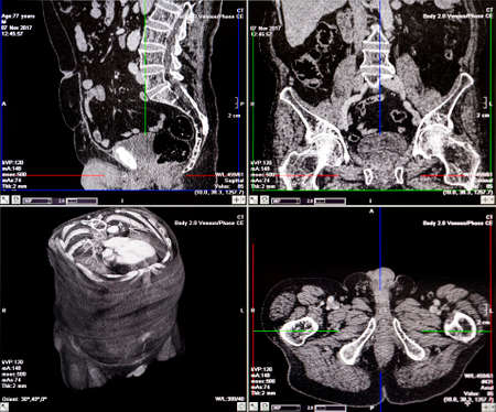 Magnetic resonance imaging (MRI) scan - CT scans of human spine on a ultrasound computer monitor.の写真素材