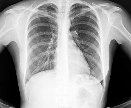 X-Ray Image Of Human Chest for a medical diagnosisの写真素材