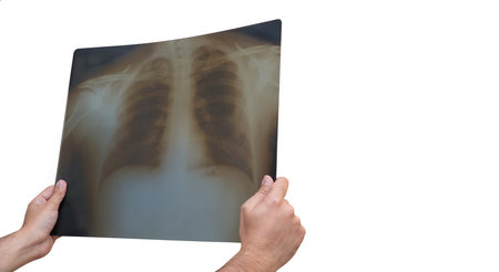 Hands Holding Radiograph Of A Lung, Isolated On White Background