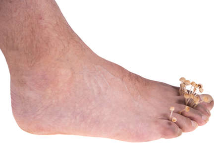 dirty infected foot mycosis on white background