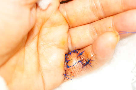 sew finger surgical thread after wound cutの写真素材