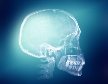 Human skull X-ray image on a blue background