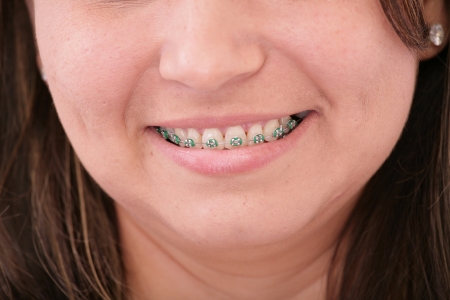 teeth with braces の写真素材