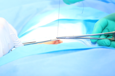 Doctor suturing open woundの写真素材