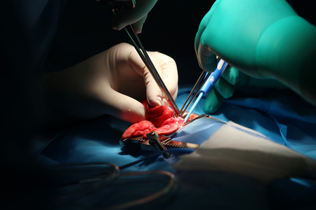 Macro shot of an infant lung surgery