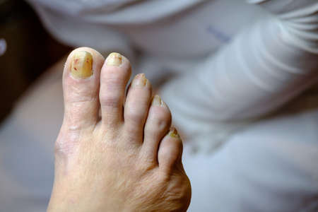 Sick unhealthy nails on the foot of a man isolatedの写真素材