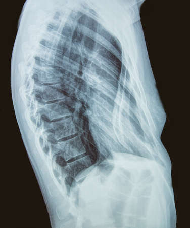 Lateral x-ray of the torso of a woman の写真素材