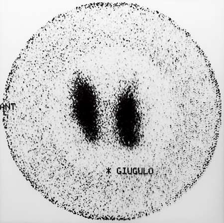 Giuguolo - scintigraphy.の写真素材
