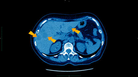 CT scan of upper abdomen : show abnormal mass at liver ( Liver cancer ).の写真素材