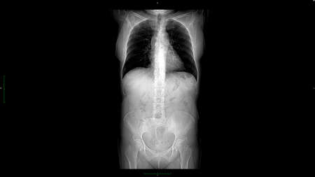 CT scan of upper abdomen.の写真素材