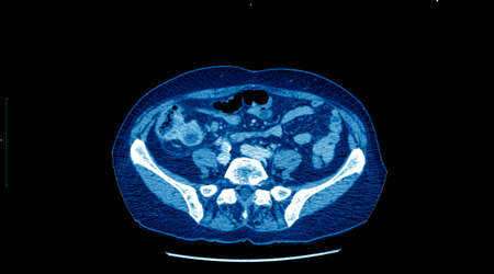 CT scan, liver cancer.